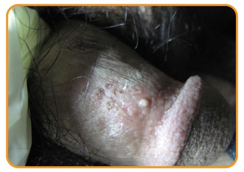 Virus del papiloma gonorrea. HPV (Human Papilloma Virus) - Papiloma aparato genital